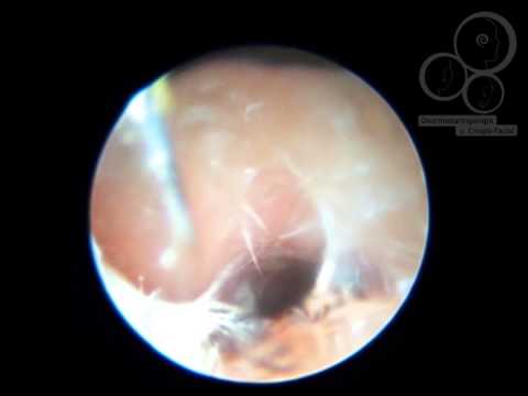 otitis externa